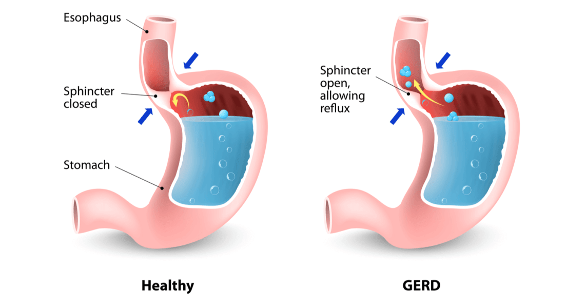 Antireflux-Surgery-GERD