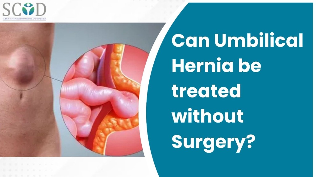 Can Umbilical Hernia Be Treated Without Surgery?