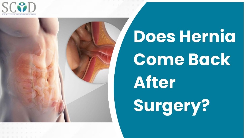 Does Hernia Come Back After Surgery?